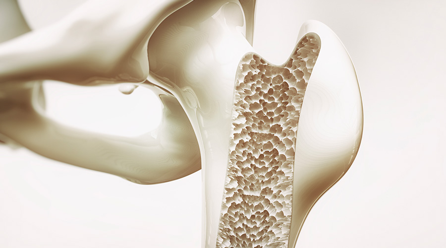 Una terapia rivoluzionaria per la cura dell’Osteoporosi.